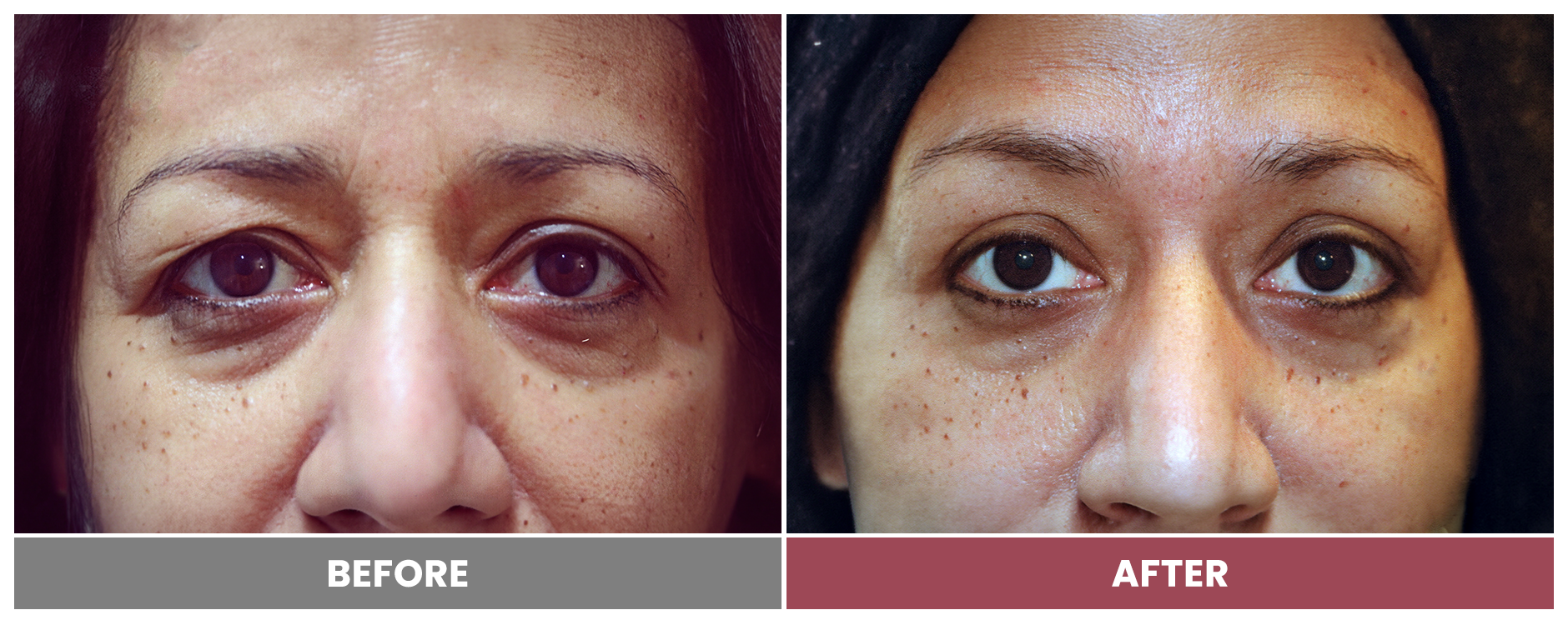Upper Blepharoplasty - Case 108